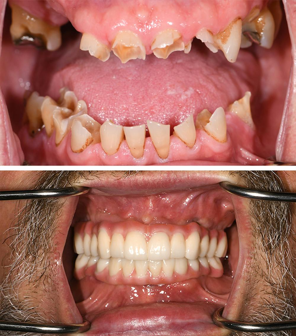 Full Mouth Reconstruction Before & After Gallery - Patient 864458 - Image 1