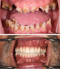 Full Mouth Reconstruction Before & After Gallery - Patient 864458 - Image 1