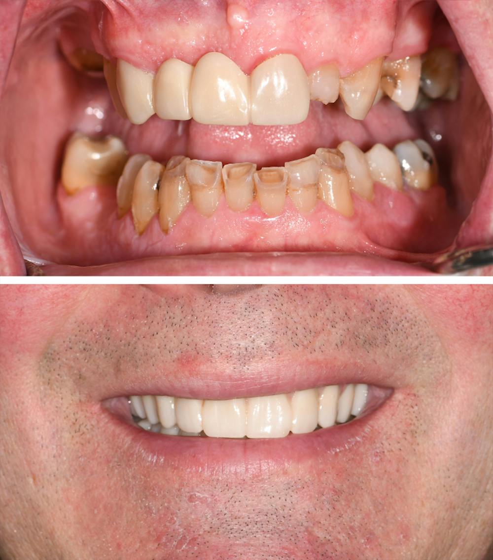 Full Mouth Reconstruction Before & After Gallery - Patient 109231 - Image 1