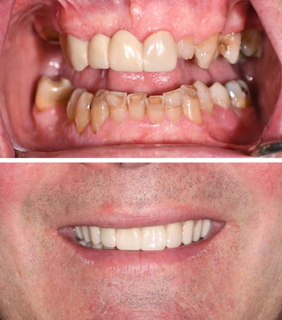 Full Mouth Reconstruction Before & After Gallery - Patient 109231 - Image 1
