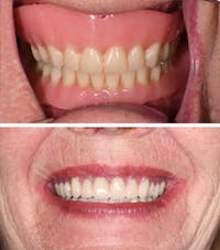 Full Mouth Reconstruction Before & After Gallery - Patient 164343 - Image 1