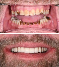 Full Mouth Reconstruction Before & After Gallery - Patient 138135 - Image 1