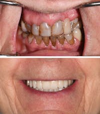 Full Mouth Reconstruction Before & After Gallery - Patient 408913 - Image 1