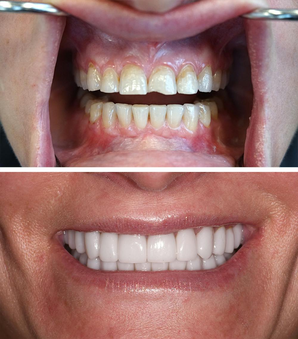 Full Mouth Reconstruction Before & After Gallery - Patient 353233 - Image 1