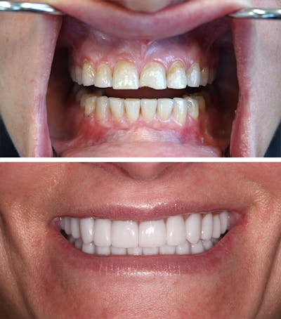 Full Mouth Reconstruction Before & After Gallery - Patient 353233 - Image 1