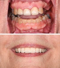 Full Mouth Reconstruction Before & After Gallery - Patient 173034 - Image 1