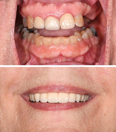 Full Mouth Reconstruction Before & After Gallery - Patient 173034 - Image 1