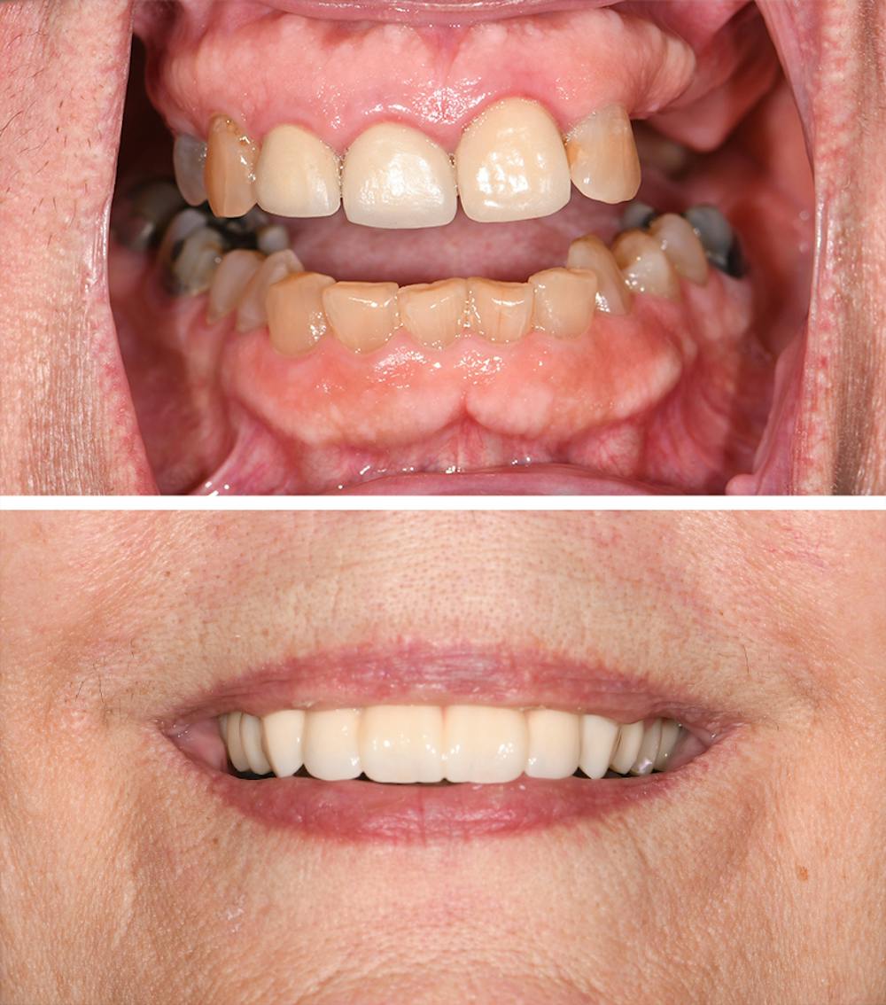 Full Mouth Reconstruction Before & After Gallery - Patient 173034 - Image 1