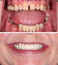 Full Mouth Reconstruction Before & After Gallery - Patient 577904 - Image 1