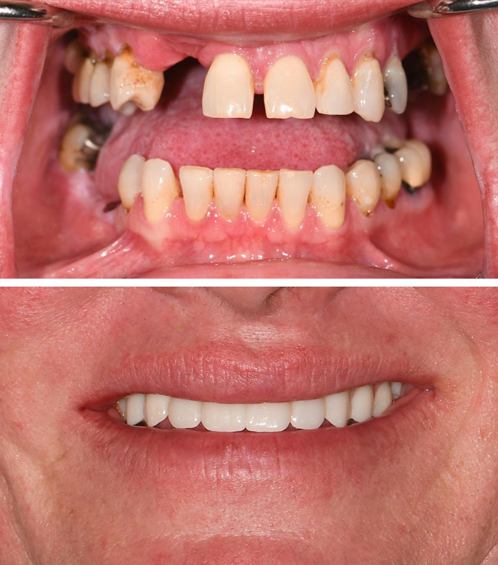 Full Mouth Reconstruction Before & After Gallery - Patient 960032 - Image 1
