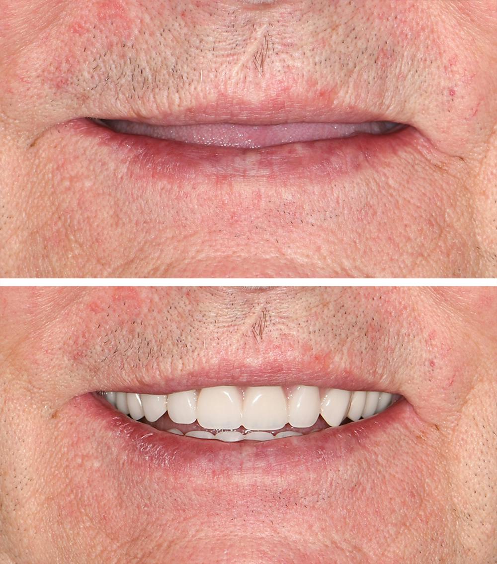 Full Mouth Reconstruction Before & After Gallery - Patient 791000 - Image 1