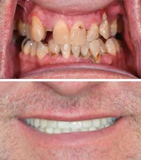 Full Mouth Reconstruction Before & After Gallery - Patient 336010 - Image 1