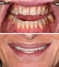 Full Mouth Reconstruction Before & After Gallery - Patient 283442 - Image 1