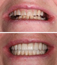 Full Mouth Reconstruction Before & After Gallery - Patient 217080 - Image 1