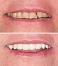 Full Mouth Reconstruction Before & After Gallery - Patient 268261 - Image 1
