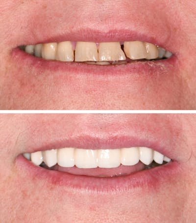 Full Mouth Reconstruction Before & After Gallery - Patient 268261 - Image 1