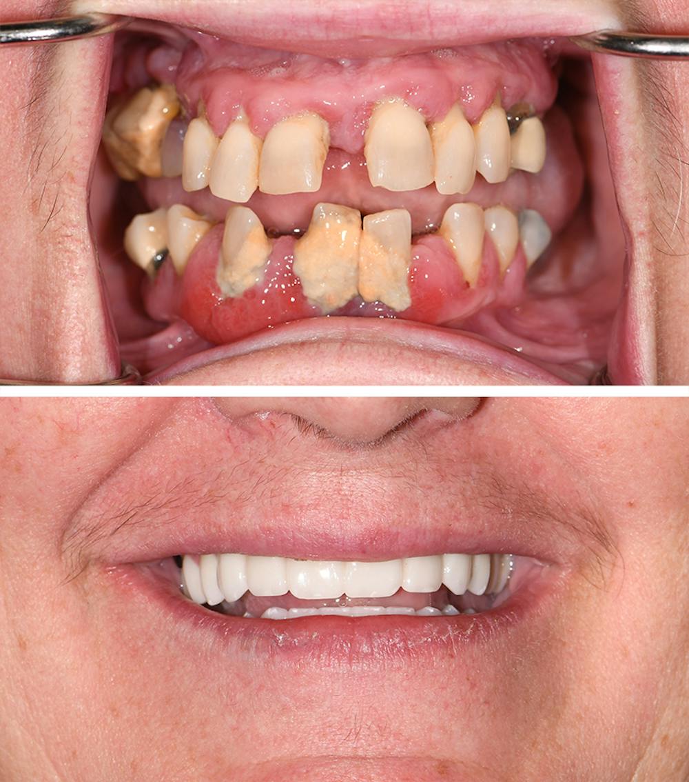 Full Mouth Reconstruction Before & After Gallery - Patient 317478 - Image 1