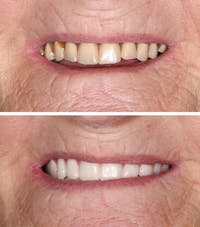 Full Mouth Reconstruction Before & After Gallery - Patient 106384 - Image 1
