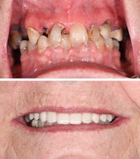 Full Mouth Reconstruction Before & After Gallery - Patient 413792 - Image 1
