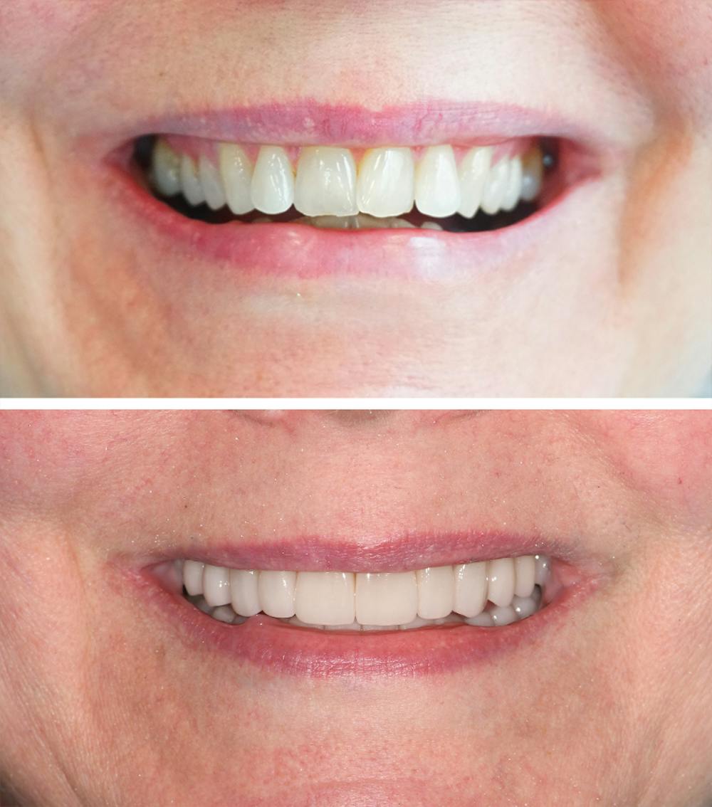 Full Mouth Reconstruction Before & After Gallery - Patient 317306 - Image 1
