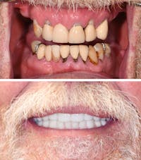 Full Mouth Reconstruction Before & After Gallery - Patient 429161 - Image 1