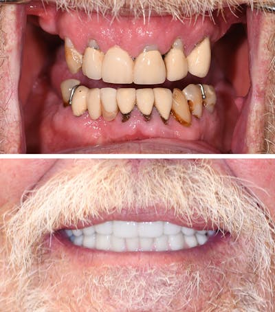 Full Mouth Reconstruction Before & After Gallery - Patient 429161 - Image 1