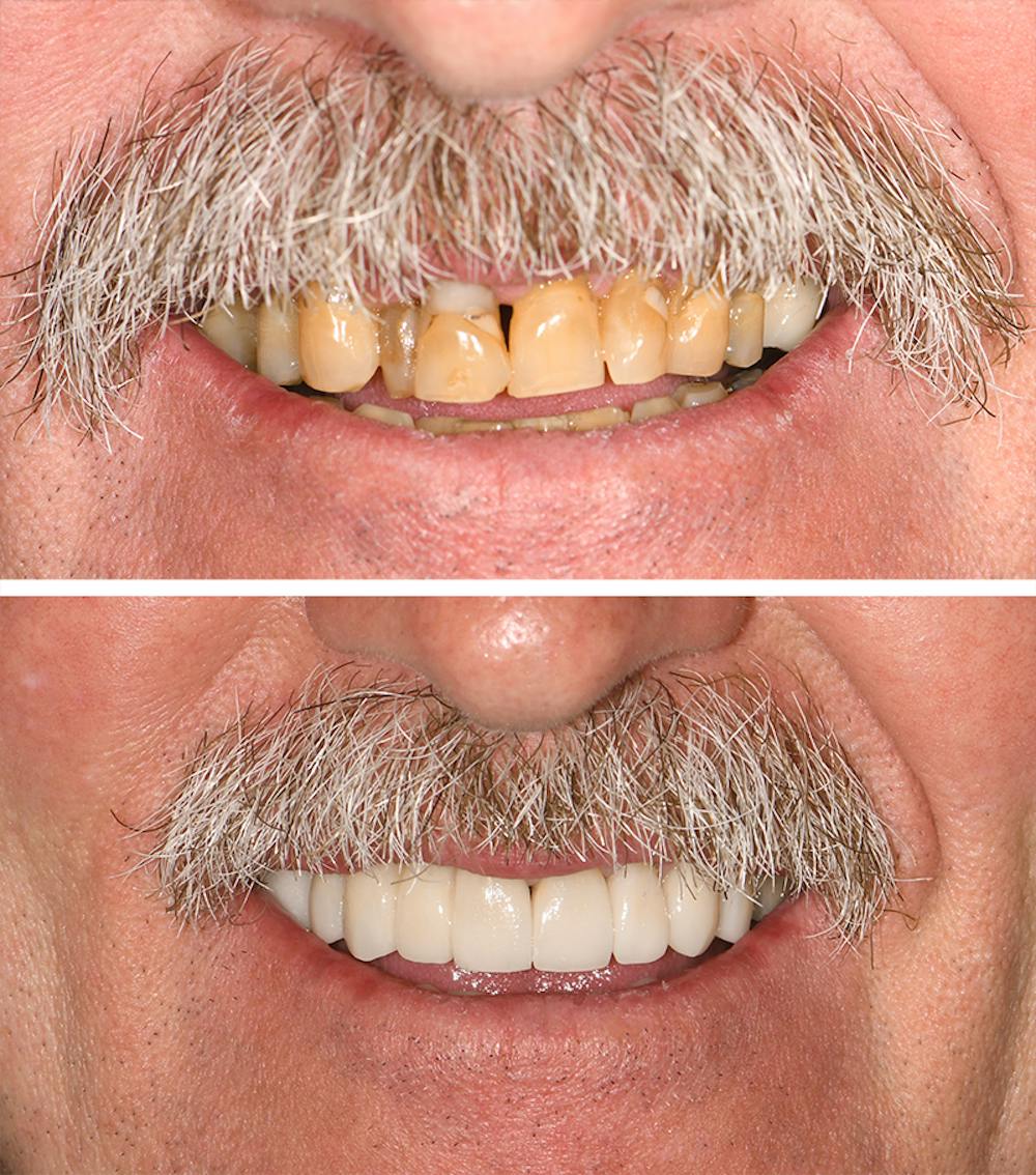 Full Mouth Reconstruction Before & After Gallery - Patient 543153 - Image 1