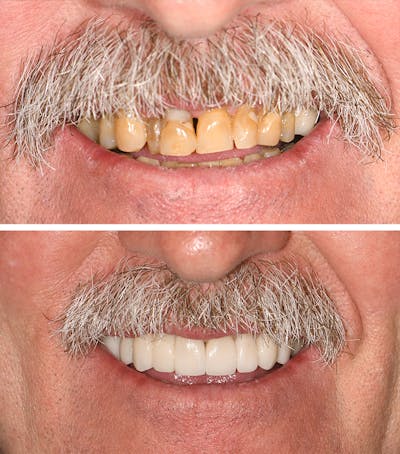 Full Mouth Reconstruction Before & After Gallery - Patient 543153 - Image 1