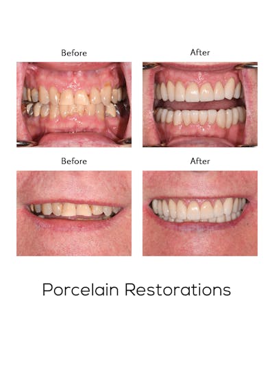 Restorations on Natural Teeth Before & After Gallery - Patient 367766 - Image 1