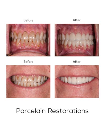 Restorations on Natural Teeth Before & After Gallery - Patient 929964 - Image 1