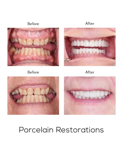 Restorations on Natural Teeth Before & After Gallery - Patient 343682 - Image 1