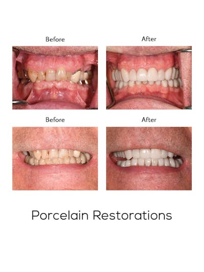 Restorations on Natural Teeth Before & After Gallery - Patient 171836 - Image 1