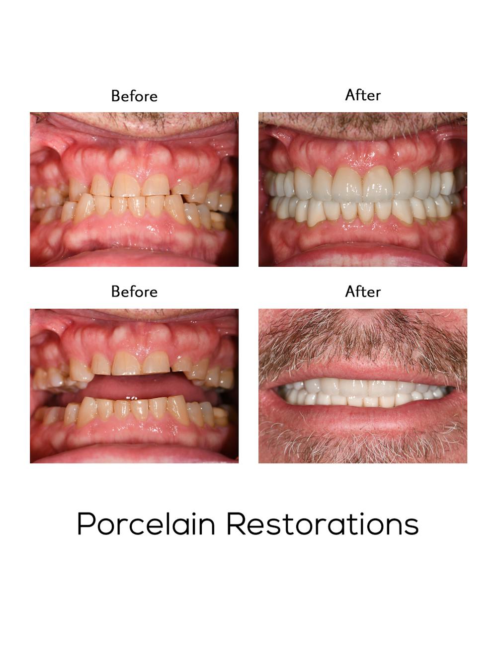 Restorations on Natural Teeth Before & After Gallery - Patient 424574 - Image 1