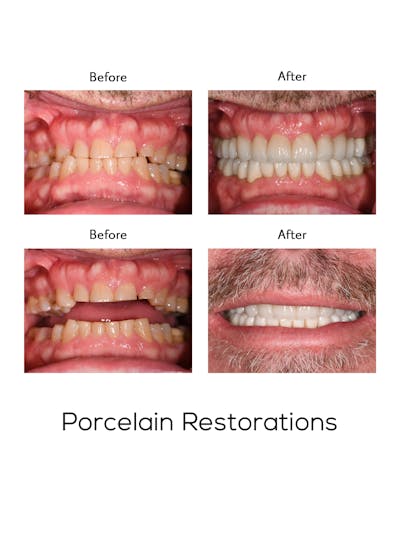 Restorations on Natural Teeth Before & After Gallery - Patient 424574 - Image 1