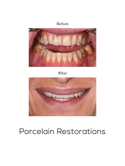 Restorations on Natural Teeth Before & After Gallery - Patient 143392 - Image 1