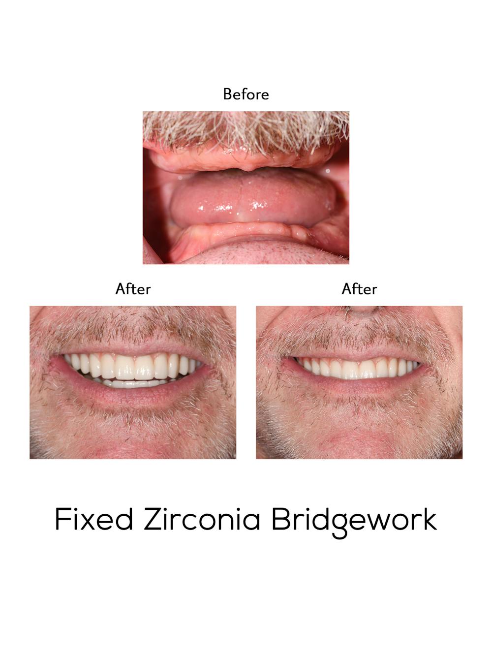 Fixed Implant Bridgework Before & After Gallery - Patient 305797 - Image 1