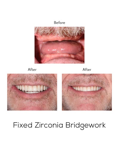 Fixed Implant Bridgework Before & After Gallery - Patient 305797 - Image 1