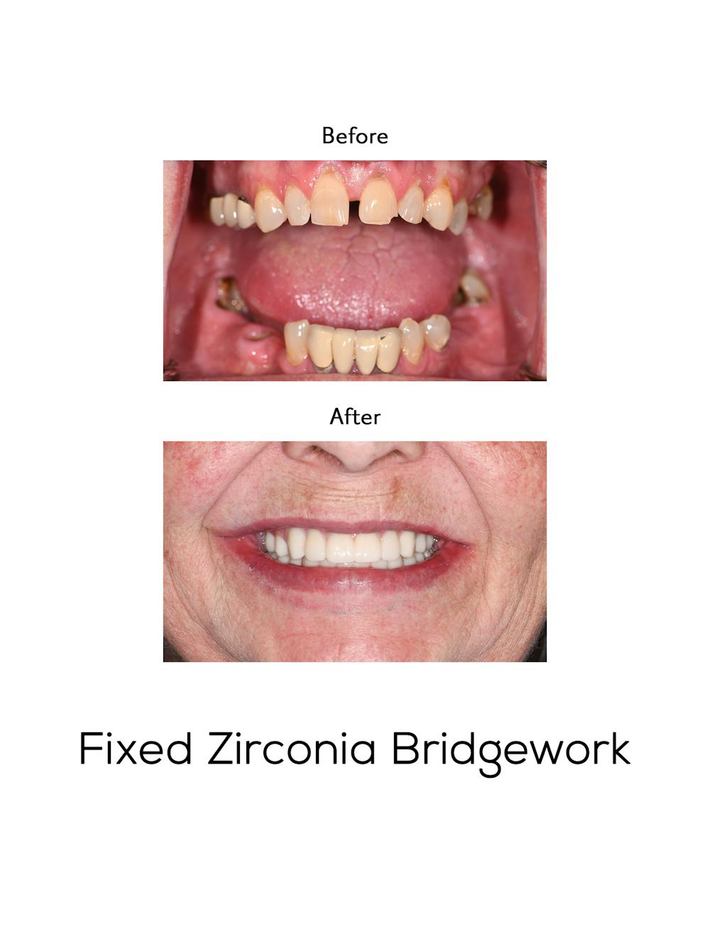 Fixed Implant Bridgework Before & After Gallery - Patient 211370 - Image 1