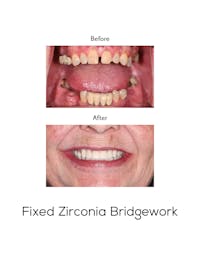 Fixed Implant Bridgework Before & After Gallery - Patient 211370 - Image 1
