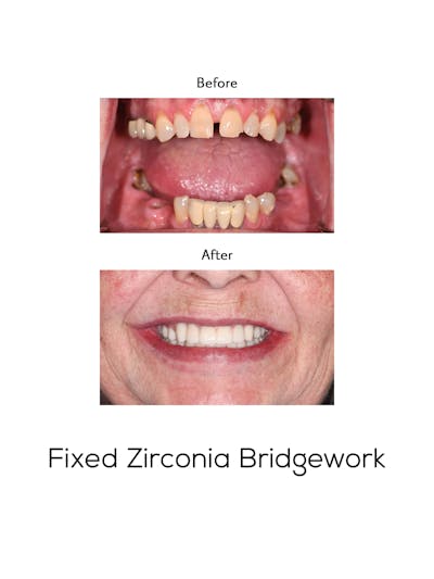 Fixed Implant Bridgework Before & After Gallery - Patient 211370 - Image 1