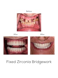 Fixed Implant Bridgework Before & After Gallery - Patient 256270 - Image 1