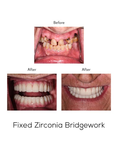 Fixed Implant Bridgework Before & After Gallery - Patient 256270 - Image 1