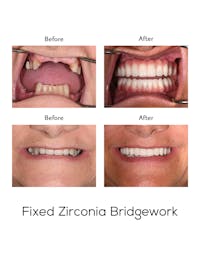 Fixed Implant Bridgework Before & After Gallery - Patient 262497 - Image 1