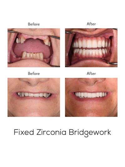 Fixed Implant Bridgework Before & After Gallery - Patient 262497 - Image 1
