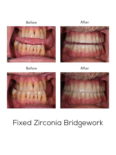 Fixed Implant Bridgework Before & After Gallery - Patient 320763 - Image 1