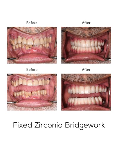 Fixed Implant Bridgework Before & After Gallery - Patient 516519 - Image 1