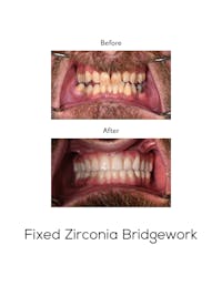 Fixed Implant Bridgework Before & After Gallery - Patient 408215 - Image 1