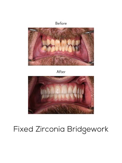 Fixed Implant Bridgework Before & After Gallery - Patient 408215 - Image 1