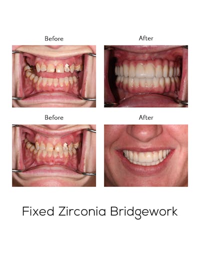 Fixed Implant Bridgework Before & After Gallery - Patient 174471 - Image 1