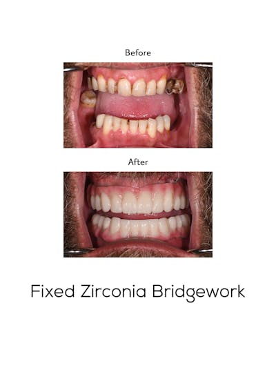 Fixed Implant Bridgework Before & After Gallery - Patient 326010 - Image 1